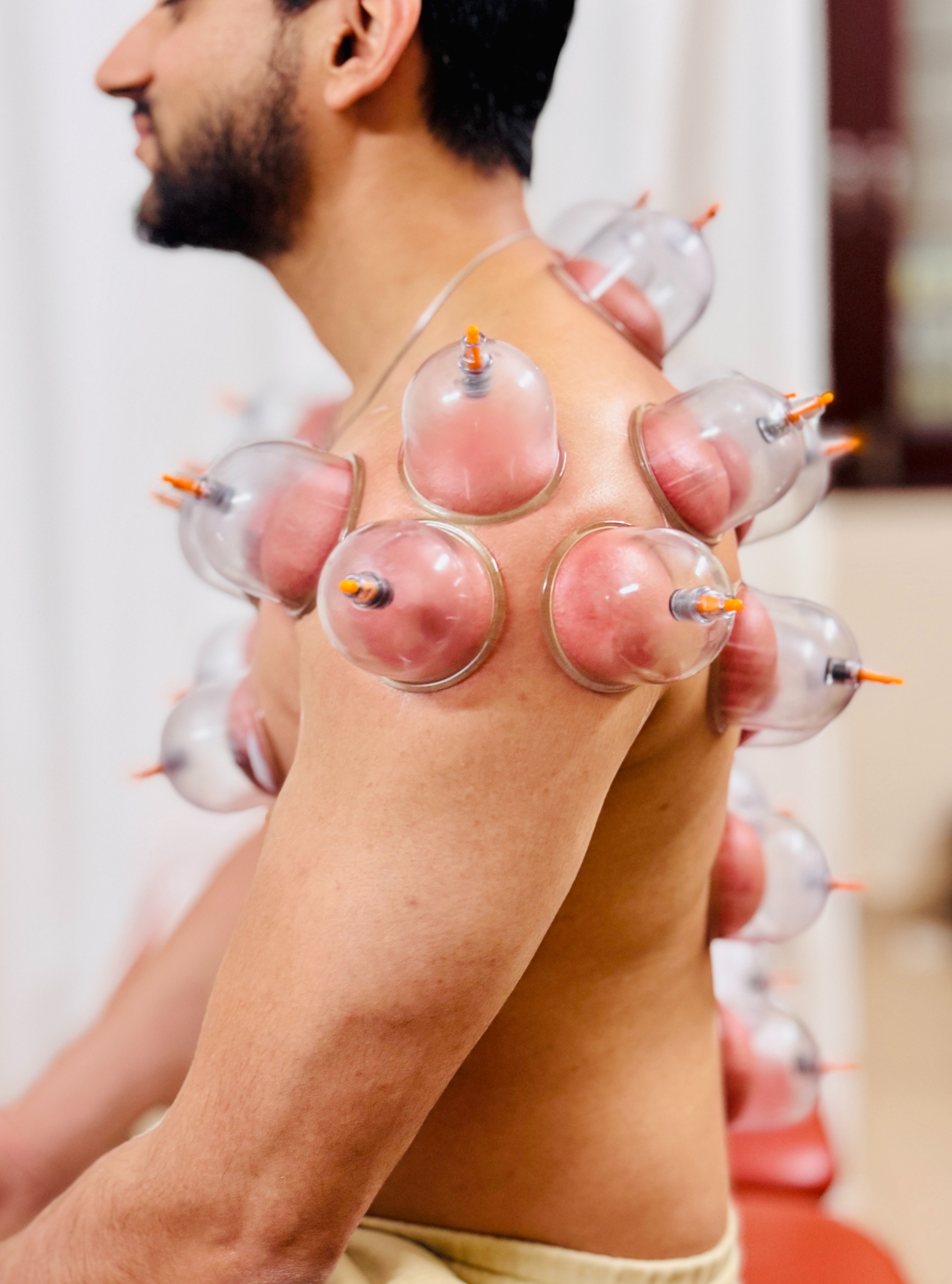 Cupping Therapy