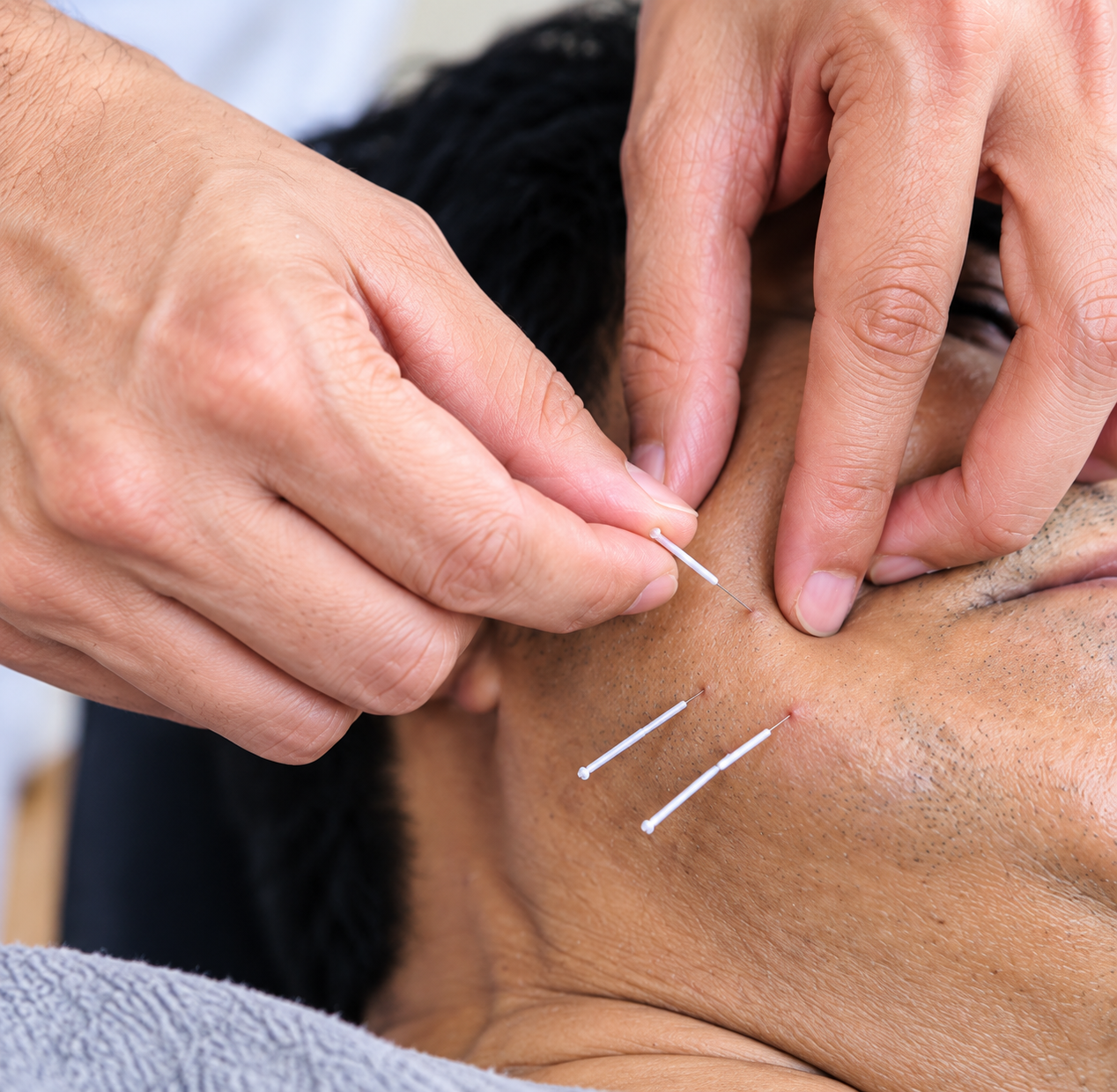 Dry Needling